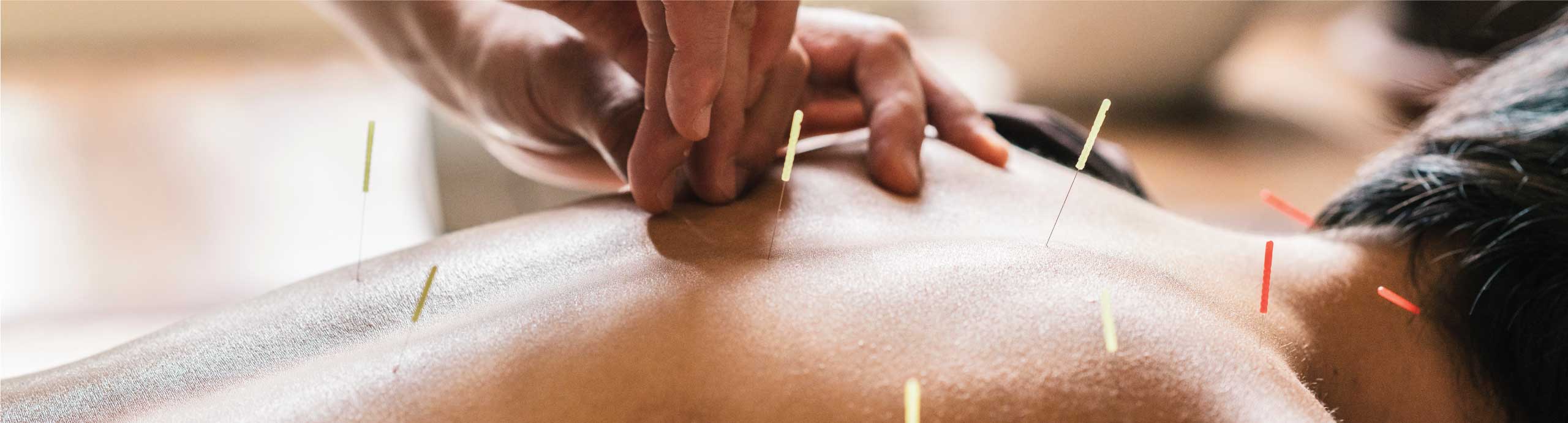 Acupuncture